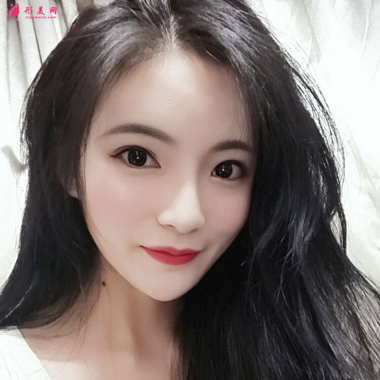 鼻部整形第十五天