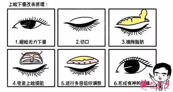 眼综合手术有几项