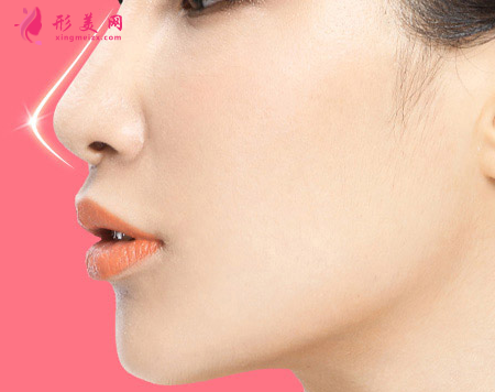 隆鼻假体多久可以取出