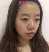 杭州维多利亚医疗美容医院双眼皮效果怎么样？亲述恢复日记