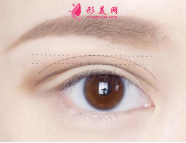 双眼皮整形的效果怎么样