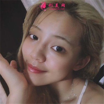 厦门小姐姐全切双眼皮术后恢复效果分享