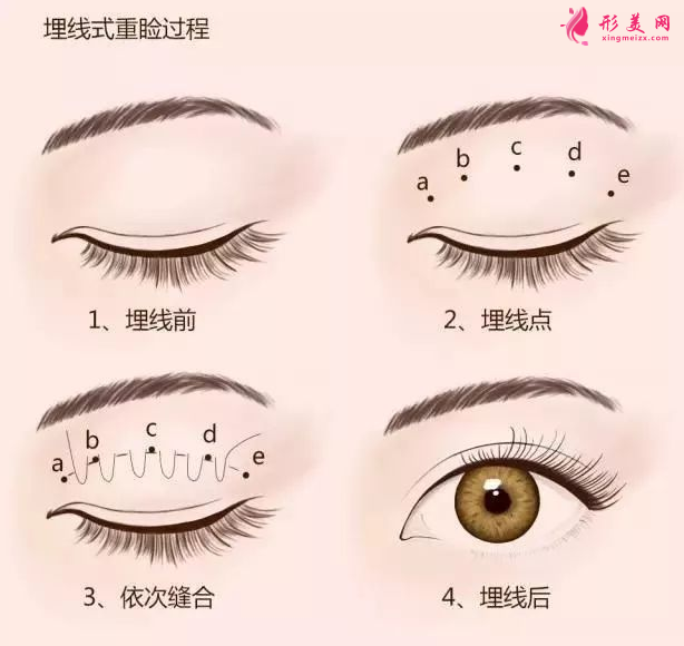 埋线双眼皮一般多久恢复正常