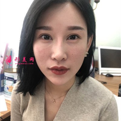 成都眼部修复手术术后效果展示