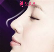 做自体软骨隆鼻安全吗？