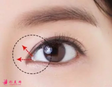 开眼角修复是怎么做的？