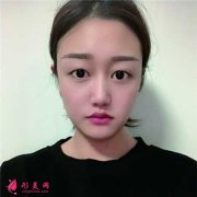 华美紫馨陈杨做双眼皮案例分享,附带最新价格表