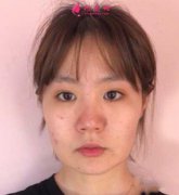 去八大处找靳小雷做了下颌角手术后,小脸不是梦