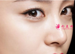 自体软骨隆鼻后会移位吗？