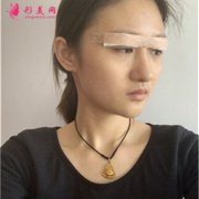 昆明市第一人民医院小姐姐眼部综合术后恢复效果反馈