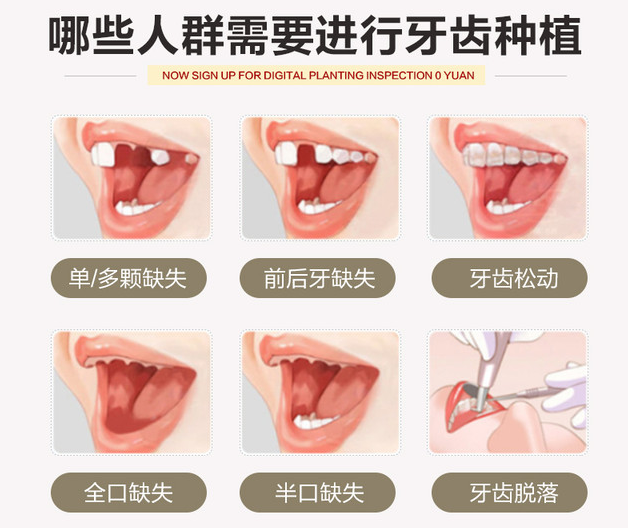 哪些人群需要进行牙齿种植