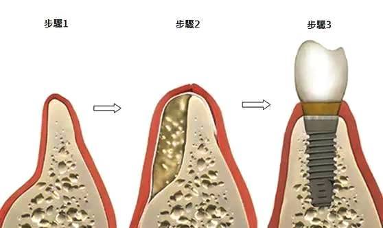 种牙好还是镶牙好区别是什么？种牙和镶牙的价格一样吗？