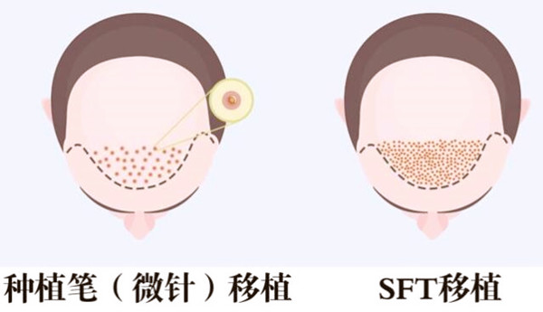 北京中德超微针植发怎么样