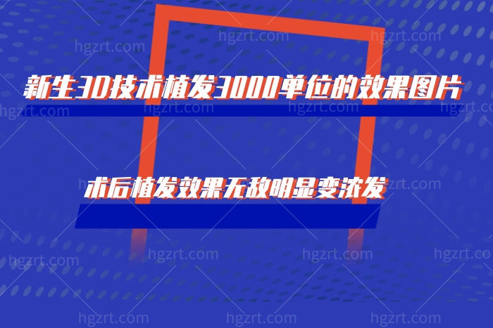 新生3D技术植发3000单位的成效图片