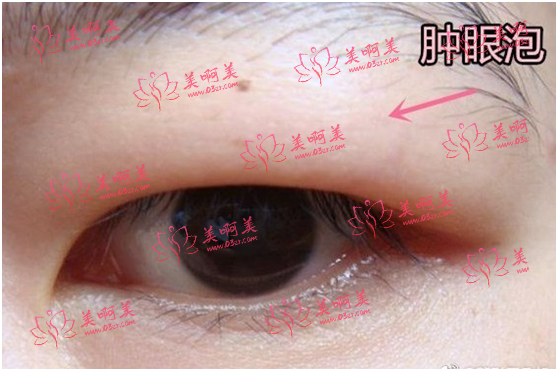 改善肿眼泡应该怎么办