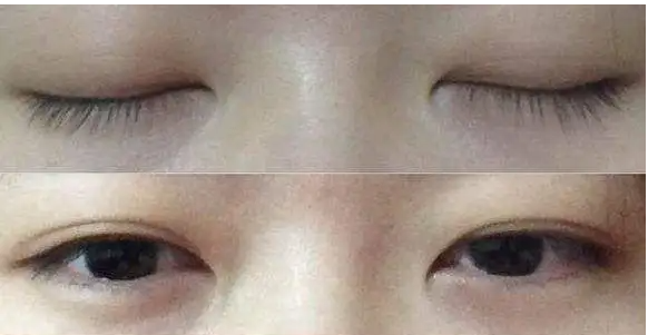 肿眼泡怎样改善