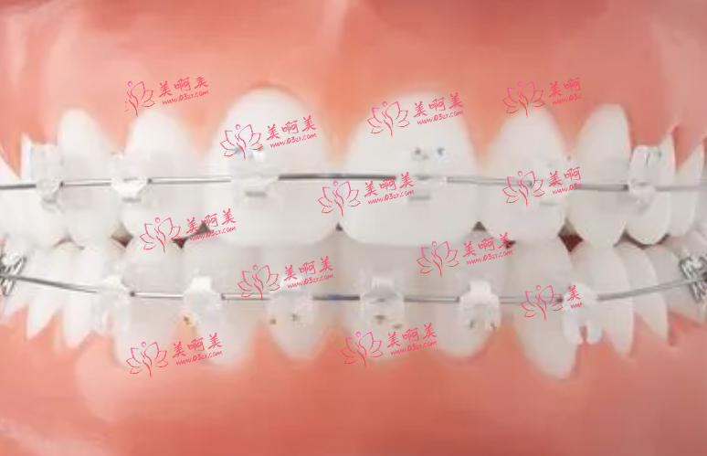 陶瓷矫正器 