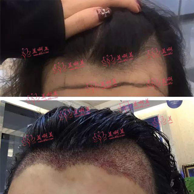 碧莲盛植发医院是私立的吗？怎么样？