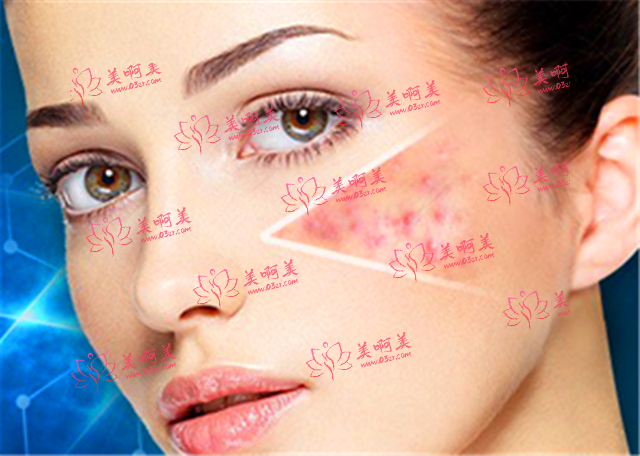 安徽省点阵激光是怎么收费的？它的价格影响因素是什么？