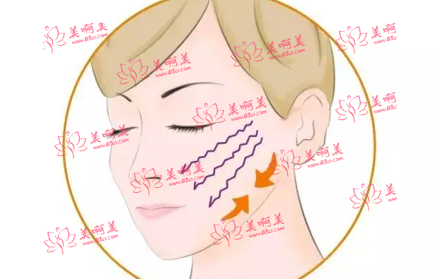 面部微创提升之后如何护理才能恢复得快？及适合人群