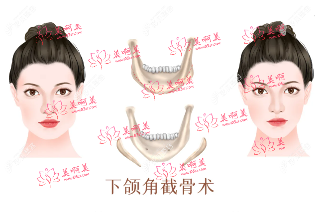 脸部磨骨有风险吗？收费大概要多少呢？