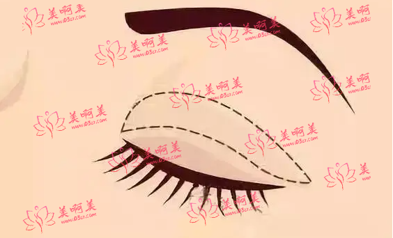 乌鲁木齐做双眼皮可以选择丽都医疗美容院吗？