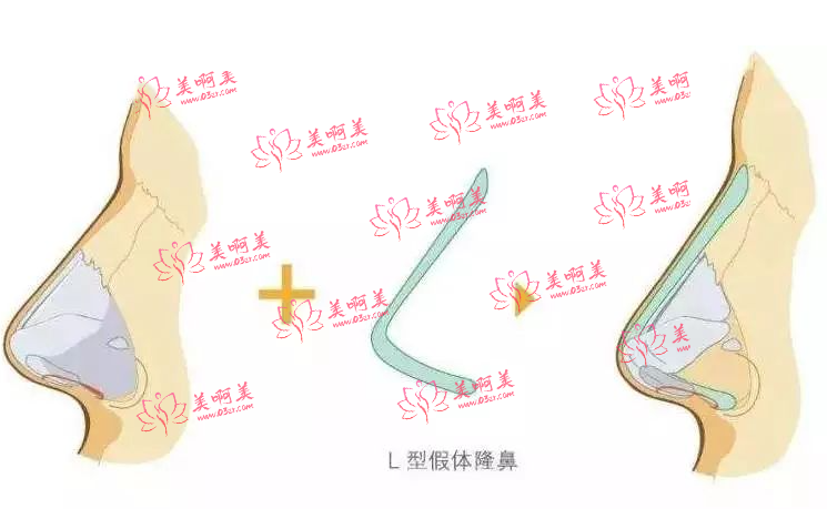 可以去临淄区人民医院整形外科做假体隆鼻吗？