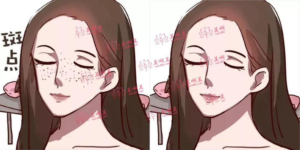 超皮秒祛斑是什么？有什么危害？术后要注意那些？