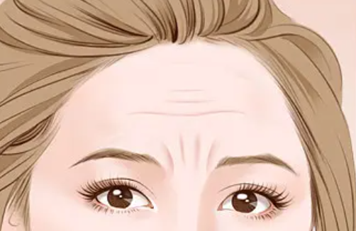 吉林市消除抬头纹医院全网安利！消除抬头纹可以管多久？