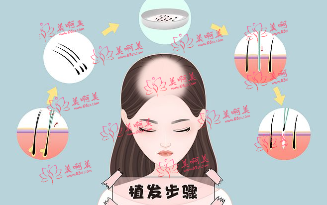 清远头发种植术价格的影响因素有？有副作用吗？效果怎样？