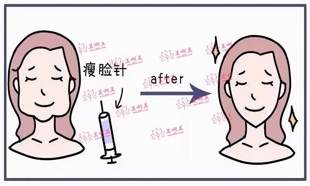 注射瘦脸的打针频率是多少？护理工作怎么做好？有副作用吗？