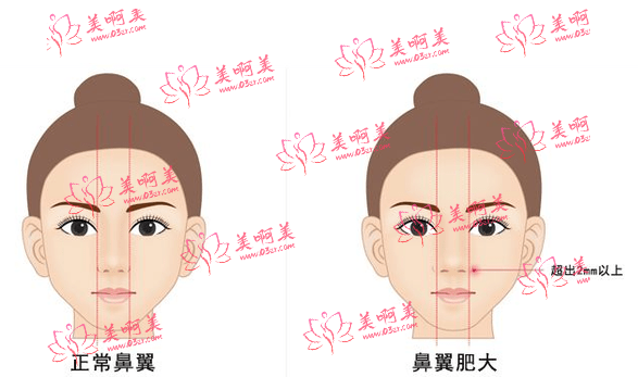 聊城鼻翼过宽整容手术的价格和什么有关？手术的适应症有哪些？