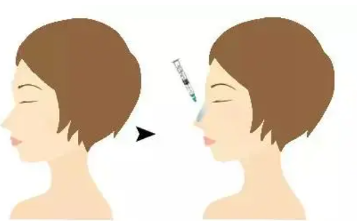 隆鼻有哪些方式？修复可以怎么办？玻尿酸隆鼻、假体隆鼻都是不错的选择！