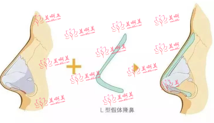 隆鼻有哪些方式？修复可以怎么办？玻尿酸隆鼻、假体隆鼻都是不错的选择！