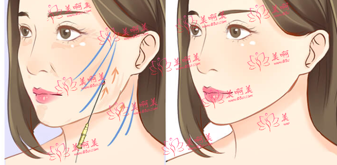 朴光哲医生现在哪家医院坐诊？做大拉皮技术和价格如何？