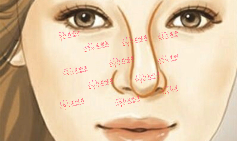 歪鼻矫正手术后还会反弹吗？术后需要注意些什么？