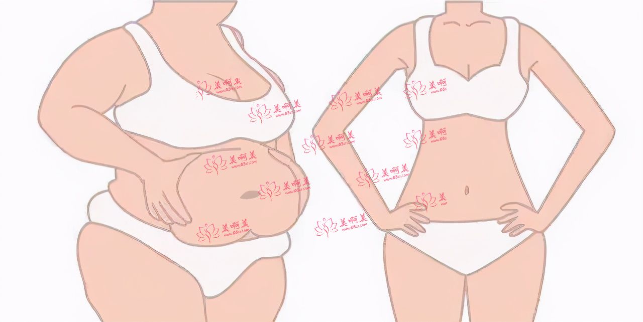 水动力吸脂手术有效吗？有什么需要注意的事项？