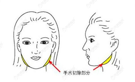 河南省中医一附院下颌角磨骨技术怎样？优势在哪里？价格贵不贵？整形案例分享