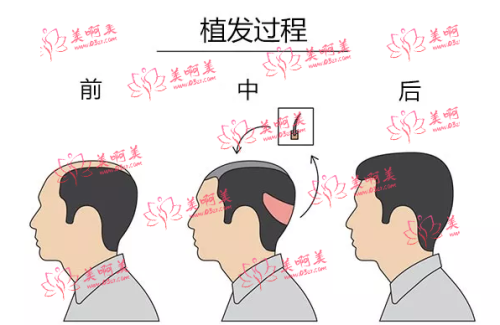 青岛熙朵植发正规靠谱吗？各种工作尽显可靠！附植发价格表