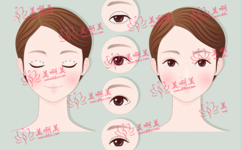 南京连天美做双眼皮技术好吗？有什么技术优势？收费贵不贵？