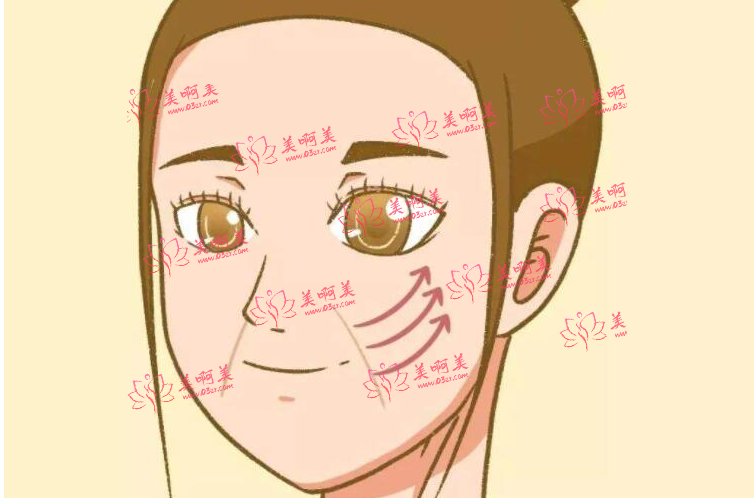 自体脂肪去法令纹的维持时间有多久？手术有什么优缺点吗？