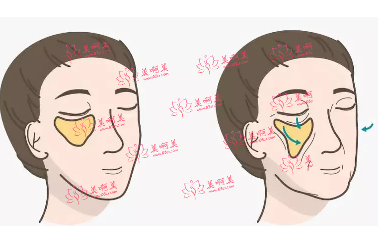 自体脂肪去法令纹的维持时间有多久？手术有什么优缺点吗？