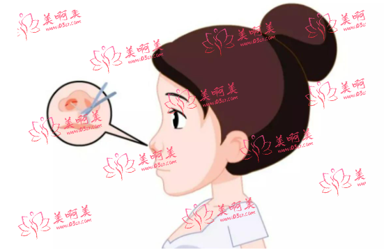 武汉协和整形外科价格表全网揭秘+隆鼻案例分享！