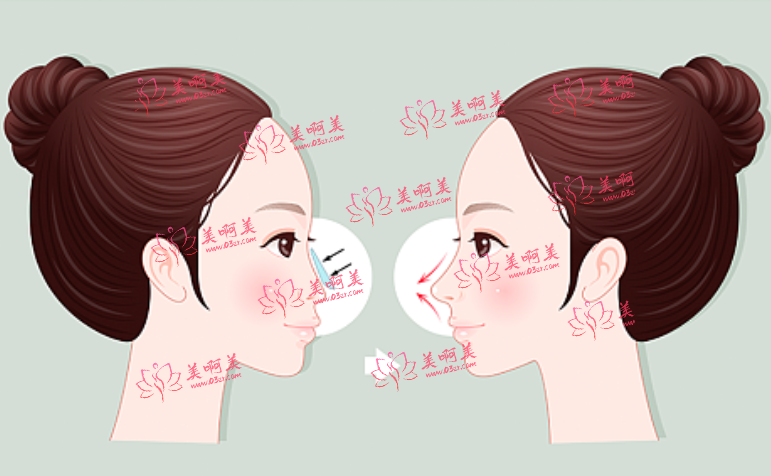 保定长城外科医院有整形科吗？来看看隆鼻案例医生技术如何？