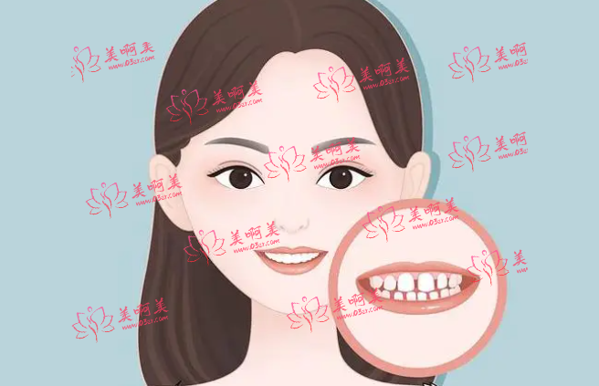 牙齿缝隙大一般是由什么原因导致的？有什么矫正方法吗？