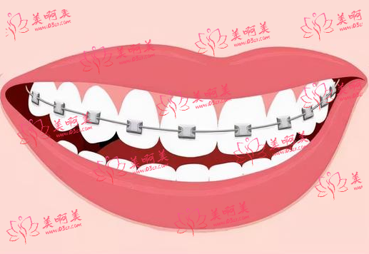 牙齿缝隙大一般是由什么原因导致的？有什么矫正方法吗？
