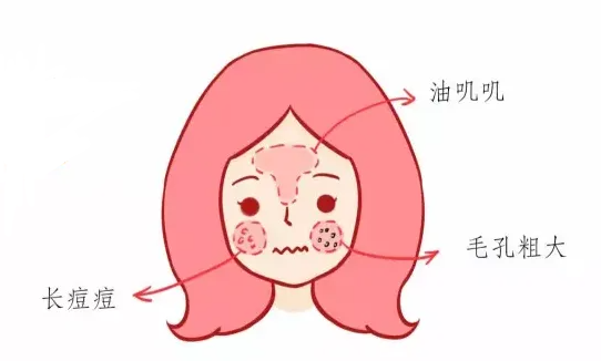 油性皮肤应该怎样选择护肤品?先来看看油皮的特点吧! 油性皮肤应该怎样选择护肤品?先来看看油皮的特点吧!