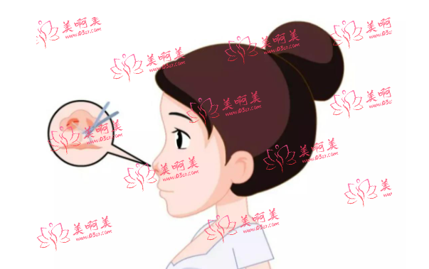 超肋鼻30000价格合理吗？影响费用的因素有哪些？维持时间多久？
