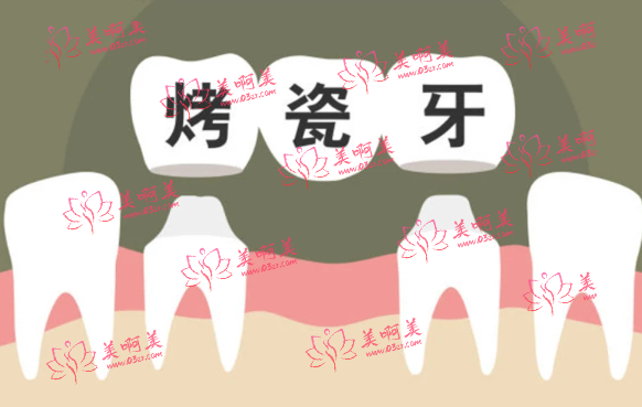 烤瓷牙会对口腔产生危害吗？烤瓷牙的价格、使用时间全面解析！