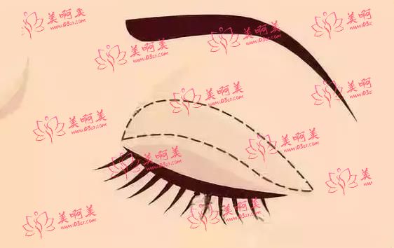韩美整形医院实力雄厚、正规靠谱！双眼皮手术案例分享！